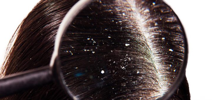 как бороться с перхотью