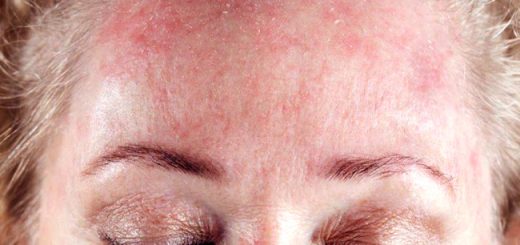 как избавиться от шелушения кожи