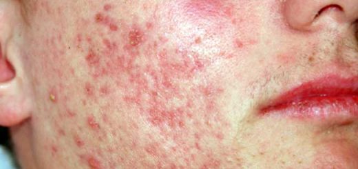 как бороться с демодекозом