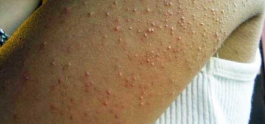 гусиная кожа