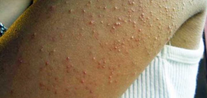 гусиная кожа