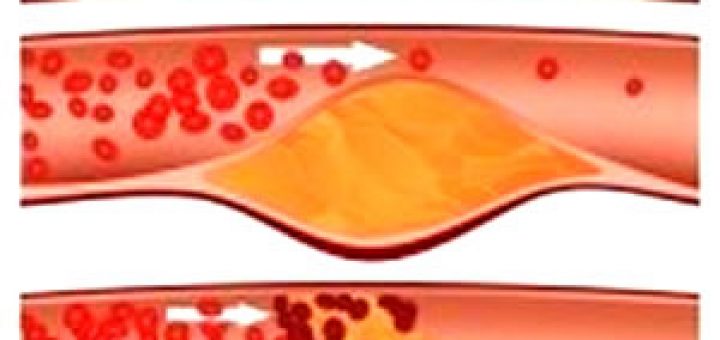 холестерин