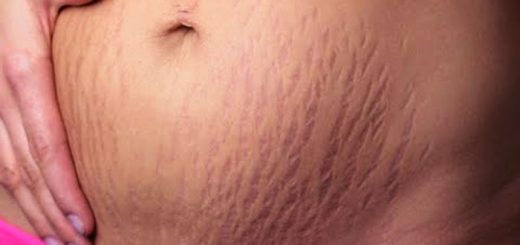 как избавиться от растяжек