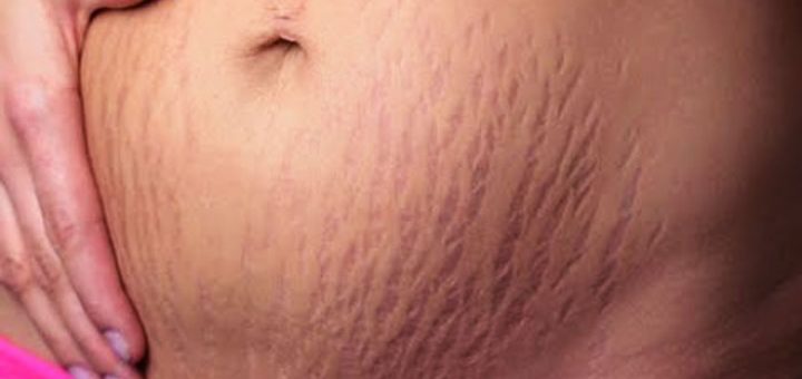 как избавиться от растяжек