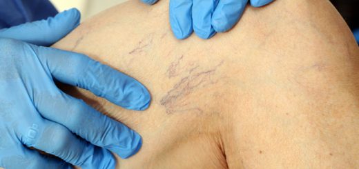 варикозное расширение вен