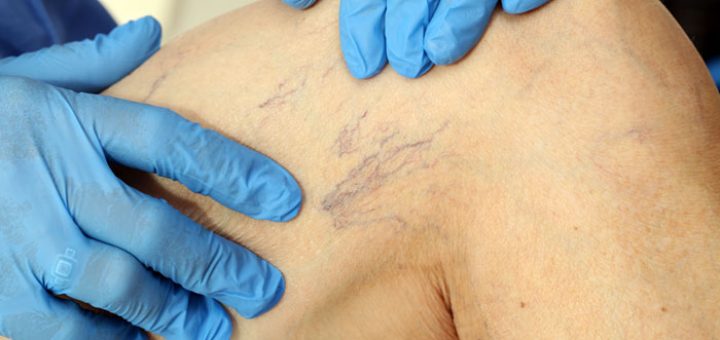 варикозное расширение вен