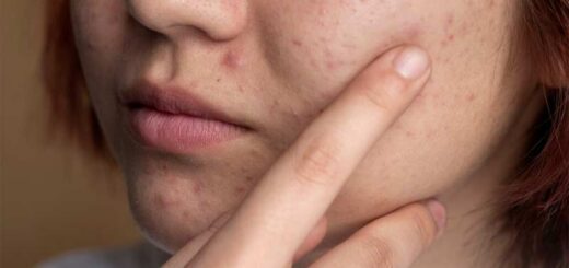 как убрать черные точки