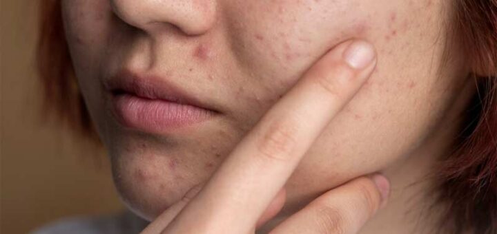 как убрать черные точки