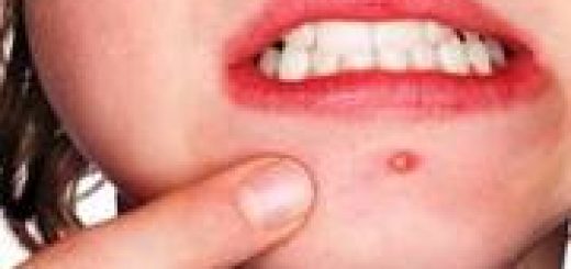 как избавиться от угрей