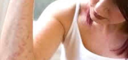 лечение дерматита в домашних условиях