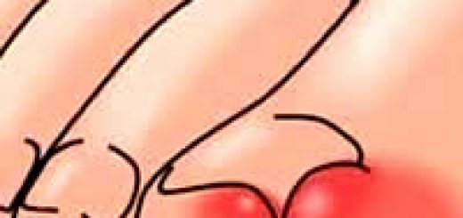 вросший ноготь