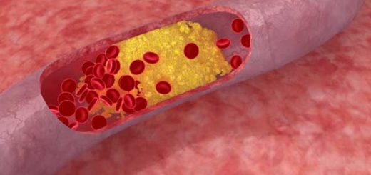 сосуды при атеросклерозе