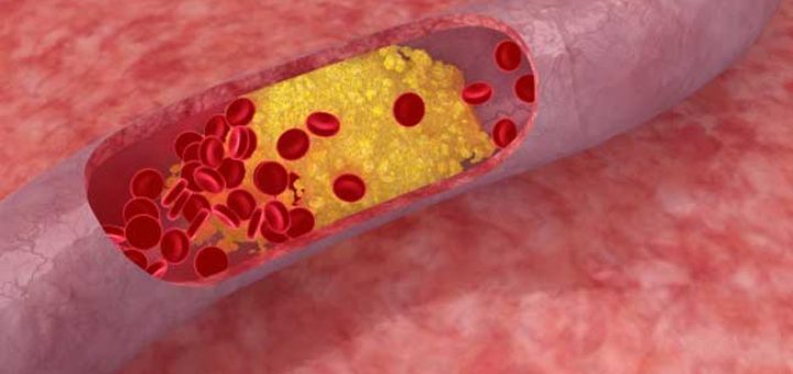 сосуды при атеросклерозе